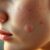 Badania na trądzik hormonalny – co warto wiedzieć?